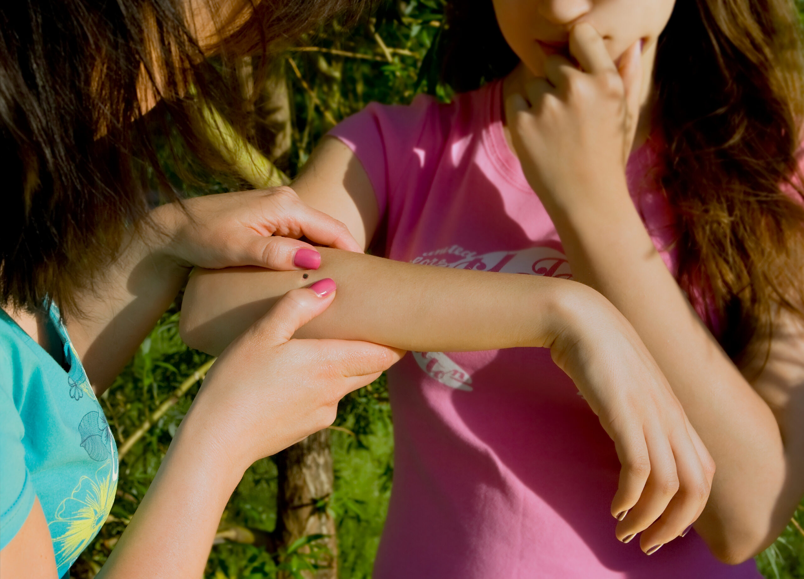 People looking at a tick embedded in human skin.