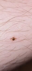 Close-up of an embedded nymphal lone star tick.