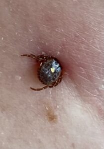 Close-up of a female lone star tick embedded in human skin.