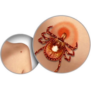 Illustration of a lone star tick on skin with a red expanding rash at the bite site, associated with STARI.